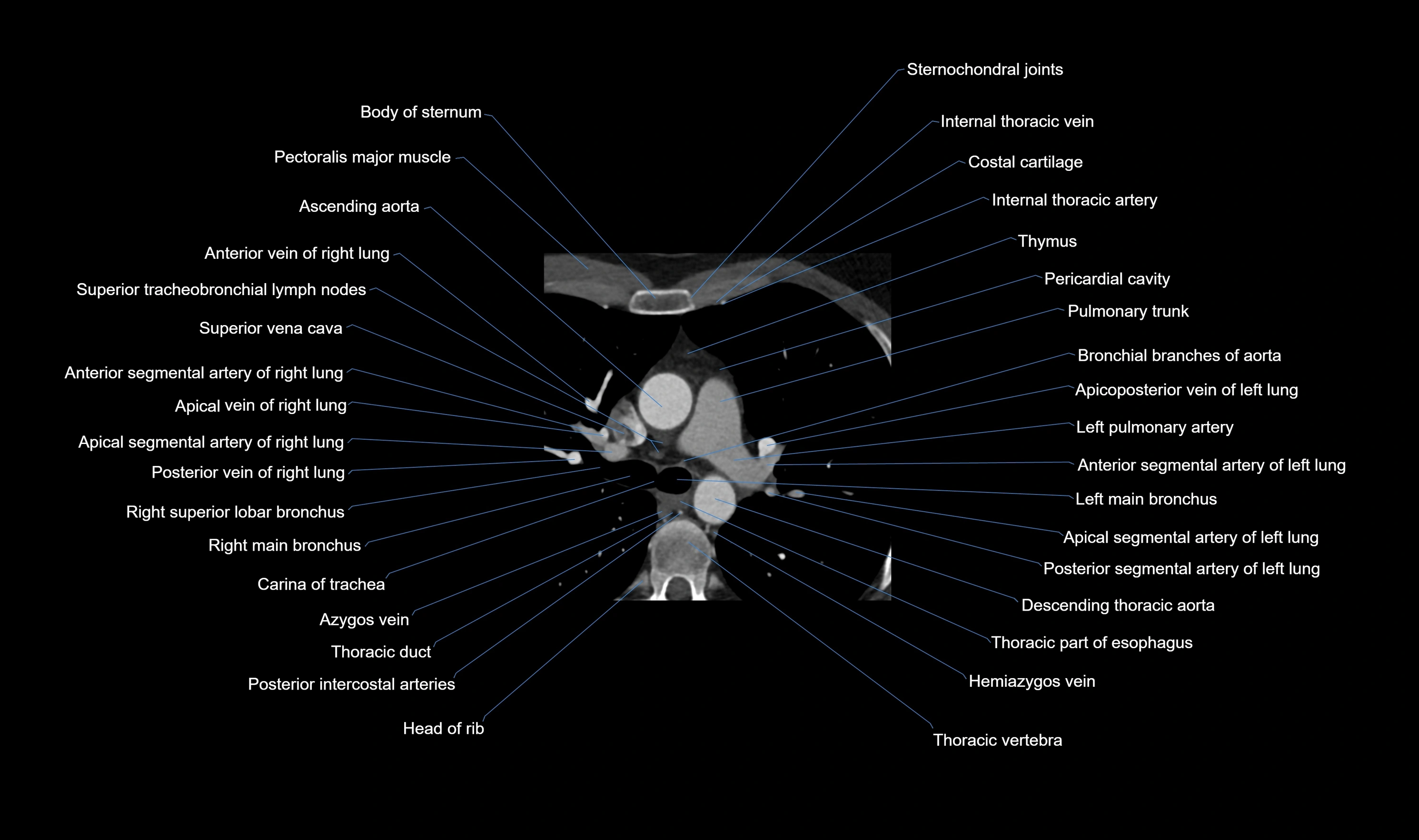 CT heart (coronary angiogram) axial view cross sectional anatomy labelled radiology image-00006.webp